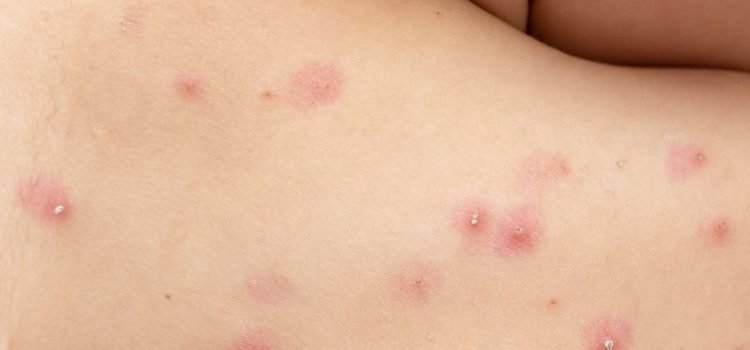 Ya son 10 los casos de viruela símica